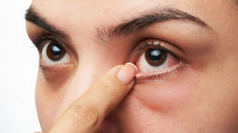 علل پرش پلک چشم یا تیک عصبی چشم 