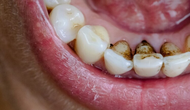 آیا مصرف آهن باعث پوسیدگی یا سیاه شدن دندان و زبان می شود؟