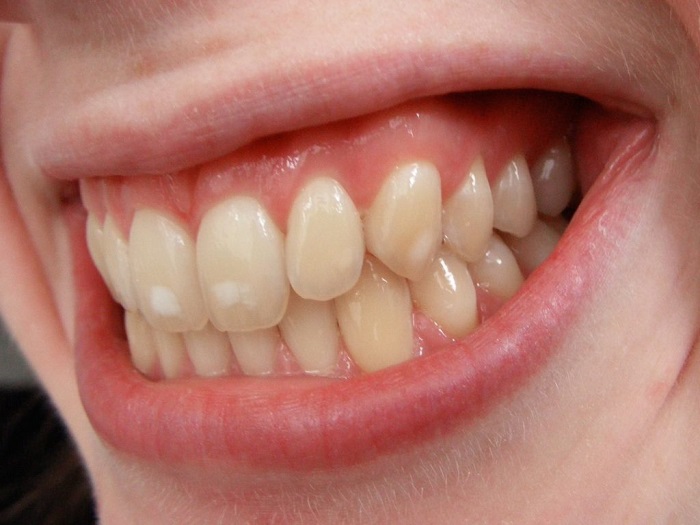 لک روی دندان و درمان آن