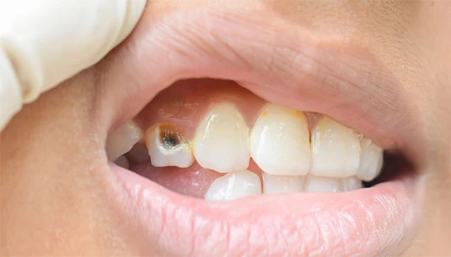لک روی دندان و درمان آن