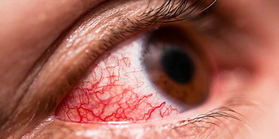 دلایل قرمزی، خارش و التهاب چشم ها