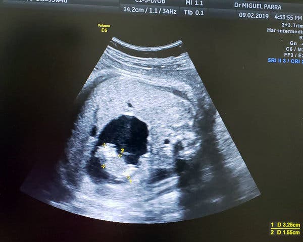Fetus in fetu - عجیب‌ترین بارداری‌های جهان