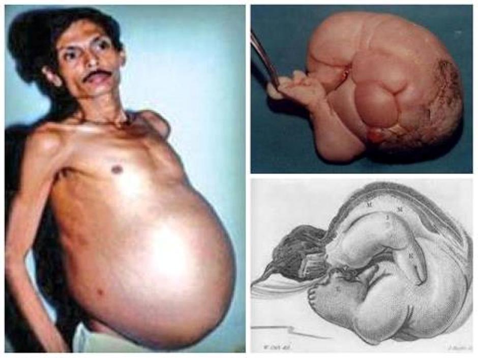 Sanju Bhagat Pregnant Man - عجیب‌ترین بارداری‌های جهان