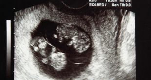 Vanishing Twin Syndrome 1 310x165 - عجیب‌ترین بارداری‌های جهان