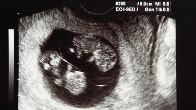 Vanishing Twin Syndrome - عجیب‌ترین بارداری‌های جهان