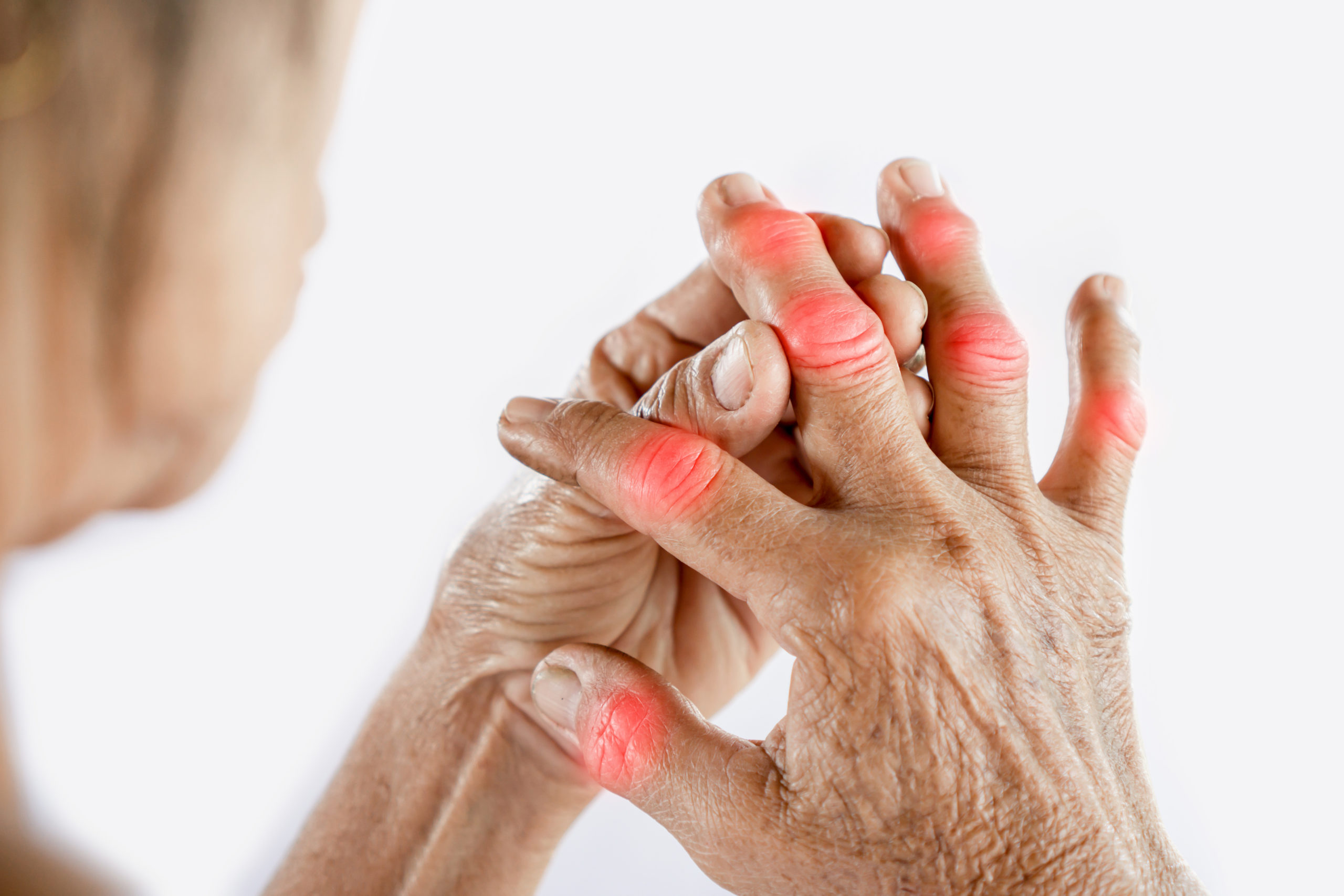 آرتریت روماتوئید چه نوع بیماری است و چه علائمی دارد؟