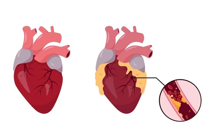 این علامت در پاها خبر از بیماری قلبی میدهد